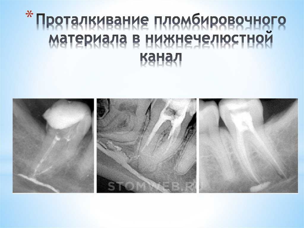 Подготовка к уколу: как открыть ампулу